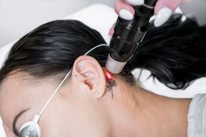 Aplicación de láser sobre un tatuaje pequeño detrás de la oreja. La animación simula cómo se aclara de arriba hacia abajo.